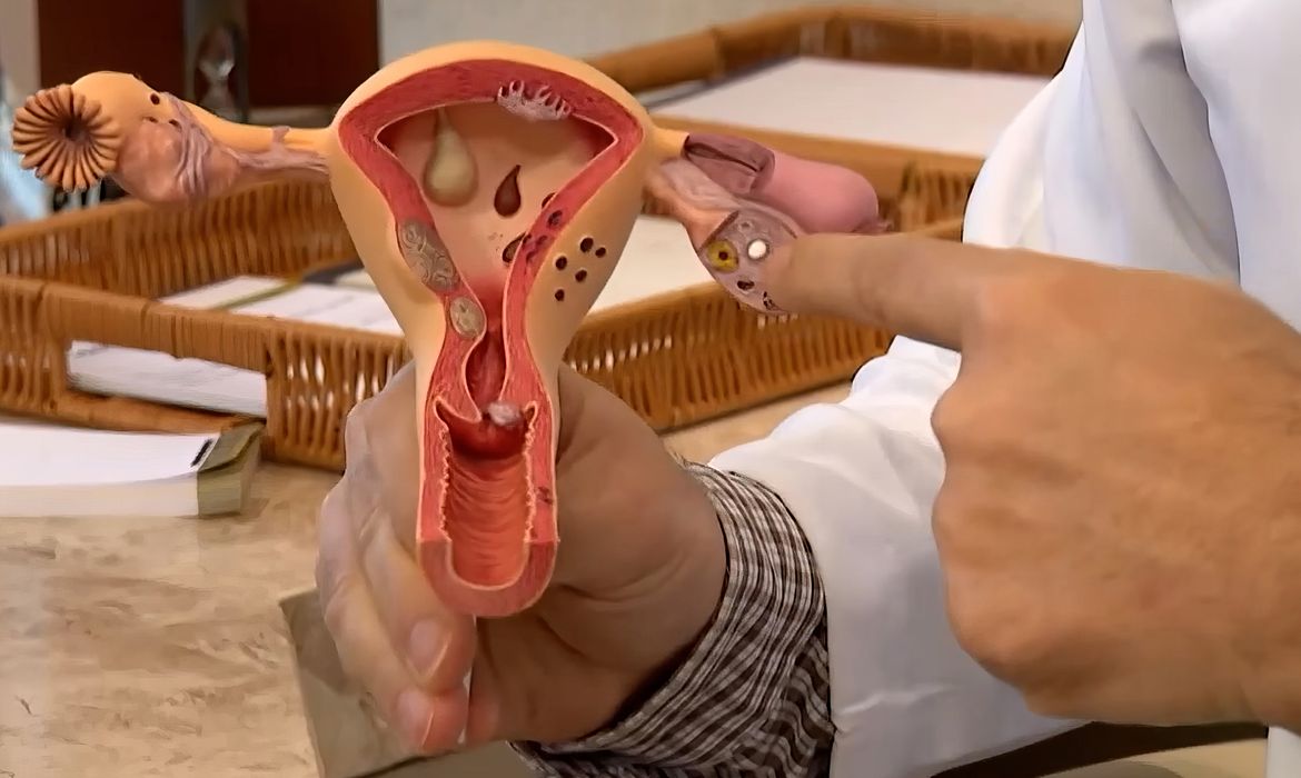 Aberta chamada pública para pesquisas sobre endometriose